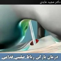 درمان پارگی رباط صلیبی قدامی