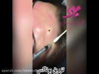 تزریق بوتاکس - کلینیک تخصصی پوست بهبد