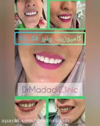 کامپوزیت دندان فک بالا