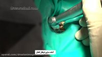 فیلم واقعی عصب کشی دندان با کیفیت بالا