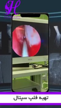 عمل ترمیم آندوسکوپیک آترزی کوان 2