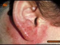 درمان حساسیت به بدلیجات