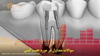 سوالات متداول در مورد عصب کشی دندان