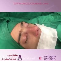 عمل همزمان بینی و زیبایی گوش