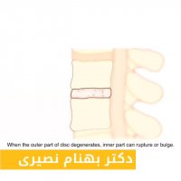 فتق دیسک کمر