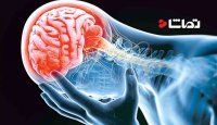 راه های تشخیص سکته مغزی
