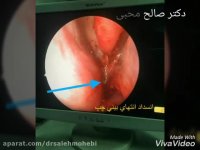 انسداد بینی در بدو تولد