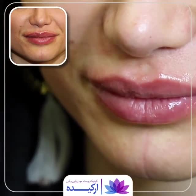 تزریق ژل لب در کلینیک ارکیده
