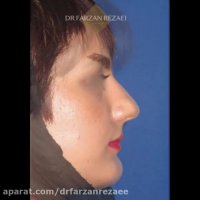 جراحی بینی گوشتی به روش بسته