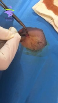 جراحی خال بزرگ