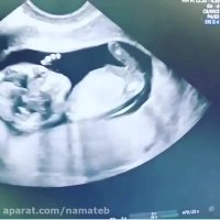 آیا سونوگرافی تنها برای تعیین جنسیت جنین است؟