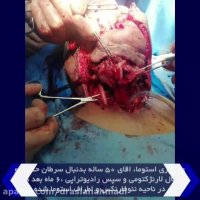 عود پری استوما