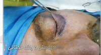 انتهای عمل بلفاروپلاستی و پلک تحتانی