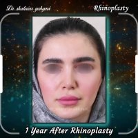 فیلم قبل و بعد از جراحی بینی