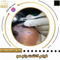کاشت مو طبیعی | کلینیک آیتک | 44221324-021