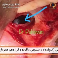 خارج سازی جسم خارجی