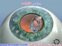 درمان کاتاراکت یا آب مروارید - مرکز چشم پزشکی دکتر علیرضا نادری