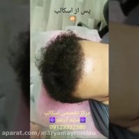 انجام اسکالپ برای رفع کم پشتی مو های سر