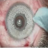 جراحی تغییر رنگ چشم