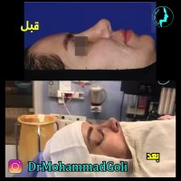 انتهای عمل بینی ترمیمی | دکتر گلی جراح بینی تهران