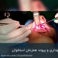 جراحی ایمپلنت دندان