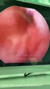 آسیب رباط صلیبی