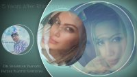 پنج سال بعد از جراحی بینی	| دکتر شهریار یحیوی