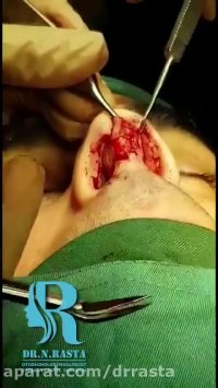 جراحی بینی گوشتی و مردانه