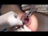 درمان قطعی بواسیر یا هموروئید با لیزر در کلینیک پایتخت