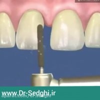 اصلاح دندان با ارتودنسی