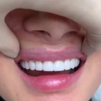 لمینت تمام سرامیکی-مرکز فوق تخصصی ایمپلنت پردیس