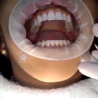 لمینت دندان