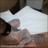 پاك كردن تتو توسط دكتر يلدا عطار زاده