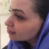 کاشت ابرو | کلینیک تخصصی رنسانس  02122088210