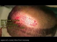 فیلم کاشت مو - روش انجام FIT دستی در کلینیک کاشت موی دکتر رضائی