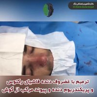 جراحی بینی ترمیمی در بیمار با کوچک شدن کلیه ابعاد بینی | دکتر باستانی نژاد