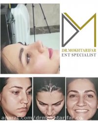 فیلم حدود سه هفته پس از جراحی زیبایی بینی گوشتی