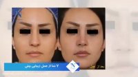 فیلم عمل جراحی بینی