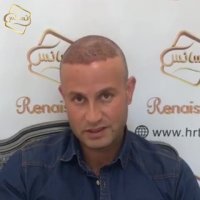 کاشت مو | کلینیک تخصصی رنسانس  02122088210