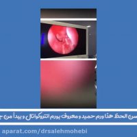 ورم انتروکوانال