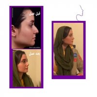 نتیجه جراحی بینی