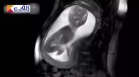 جا به جایی دیدنی جنین در شکم مادر