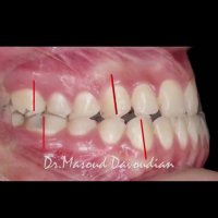 ارتودنسی همراه جراحی فک | دکتر داودیان