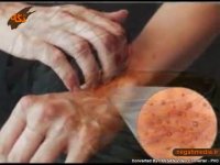 درمان حساسیت به بدلیجات