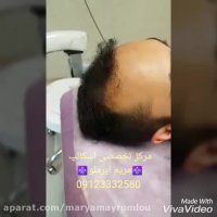 انجام اسکالپ بعد از کاشت برای افزایش تراکم