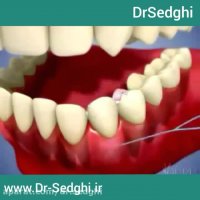 تمیز کردن دندان با بریچینگ