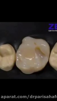 فیلم واقعی ترمیم کامپوزیت دندان ها!