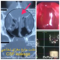 نشت مایع مغزی نخاع