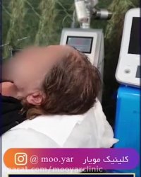 کرونا و ریزش مو