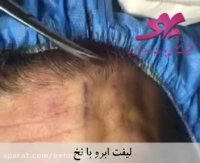 لیفت ابرو با نخ -2 کلینیک تخصصی پوست بهبد